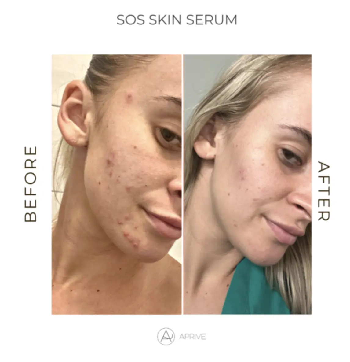 serum-bha-prije-poslije