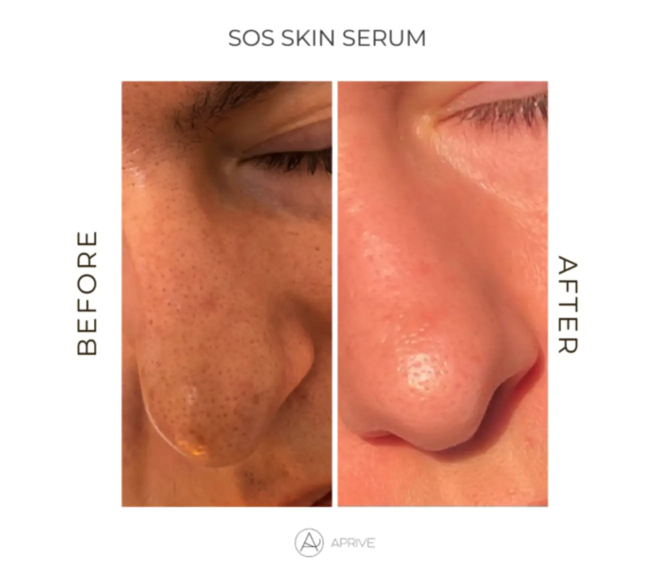 salicilna-kiselina-prije-i-poslije