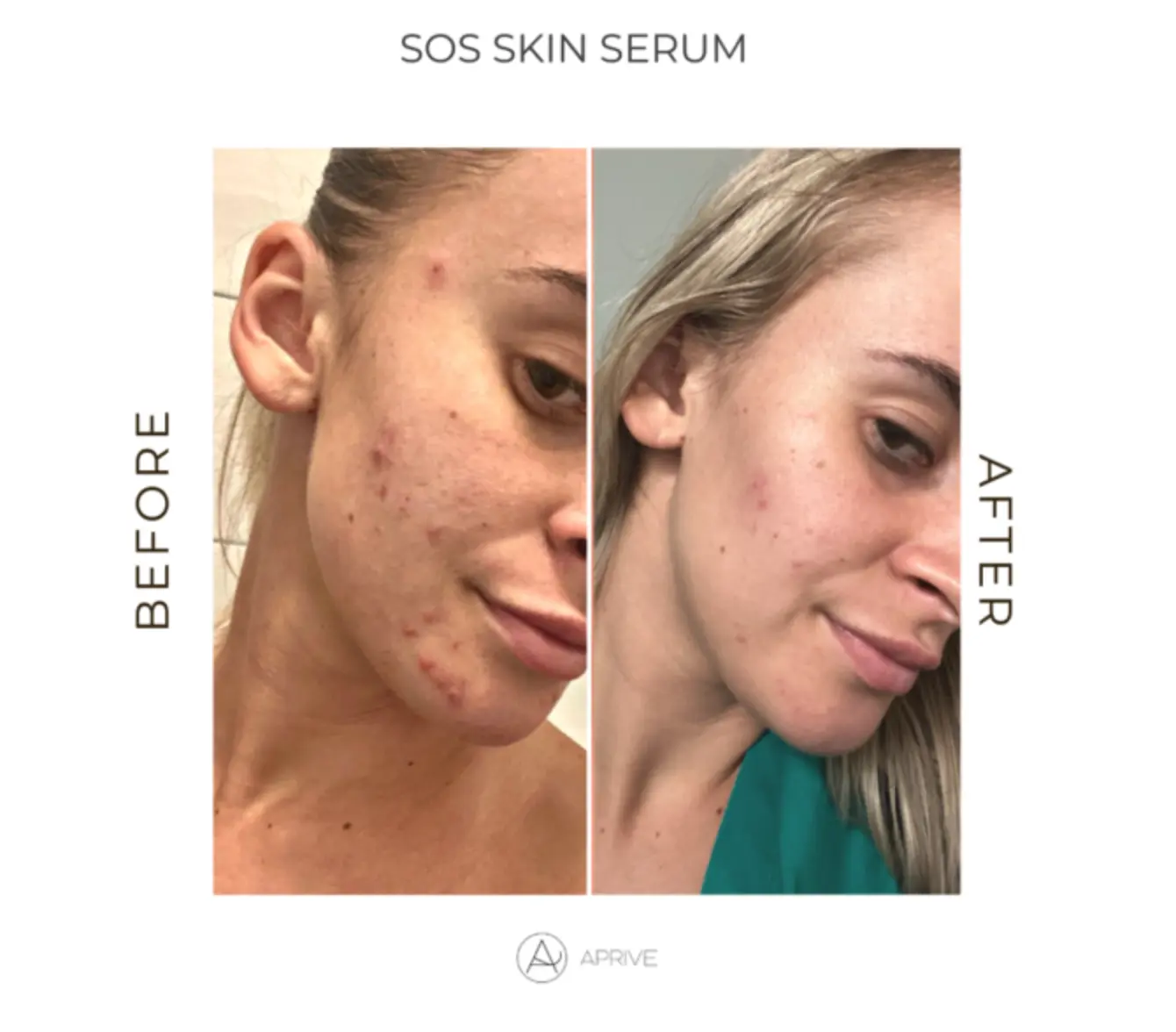 salicilna-kiselina-za-lice-iskustva